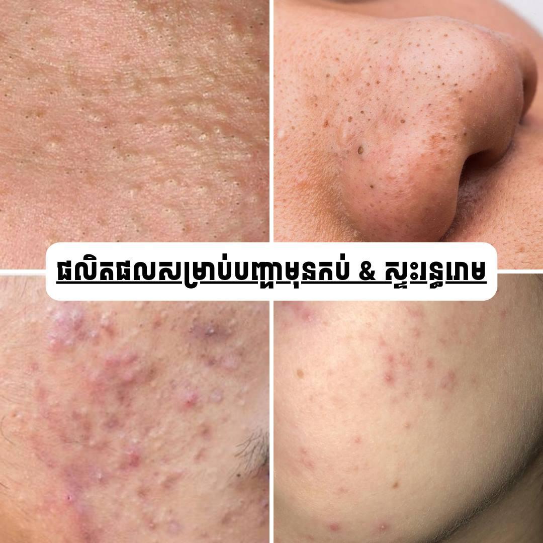 ផលិតផលព្យាបាល​ មុន​ កប់